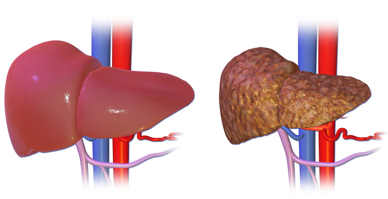 hepatite b hepatititis b epatite b